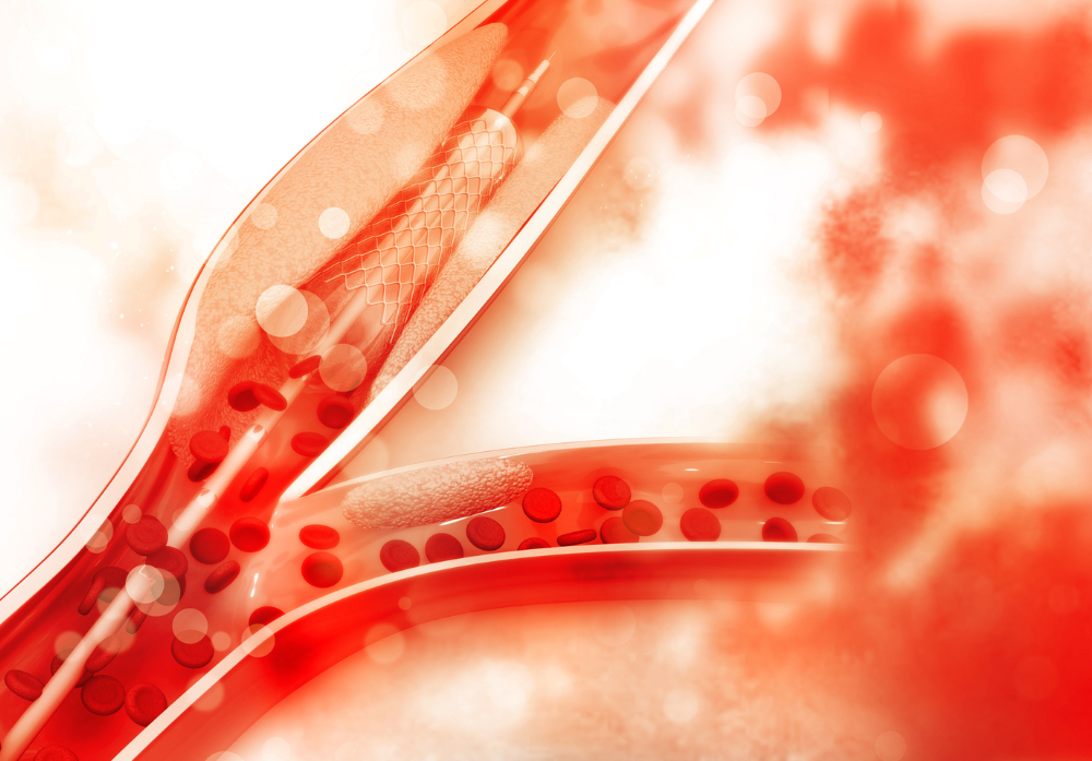 Imagem de artérias com Stents implantados